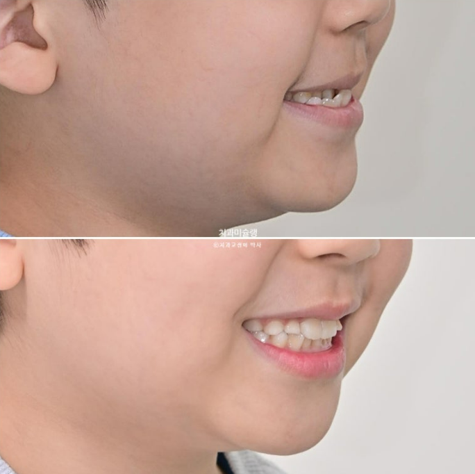 7세 어린이 반대교합 부정교합 프리올소 치료 관련 이미지 1