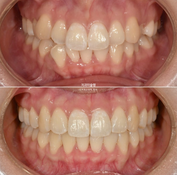 인비절라인 비발치 토끼이빨 교정 덧니 교정 치료기간 1년 8개월 관련 이미지 13