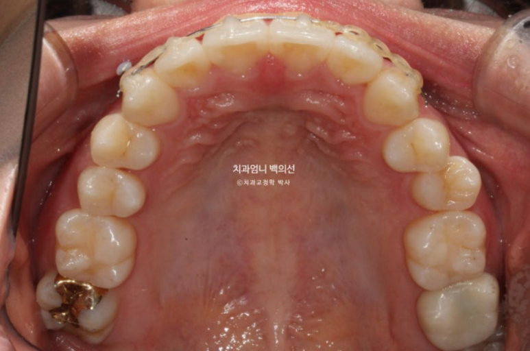 앞니 부분 교정 급속 교정 토끼이빨 MTA 미니튜브 치간삭제 치료기간 9개월 관련 이미지 9