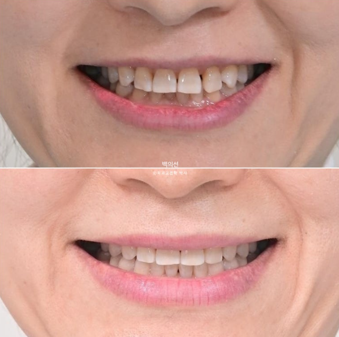 50대 치아교정 :: 인비절라인 익스프레스 치아 벌어짐 단기교정 후기 관련 이미지 19
