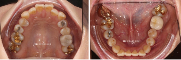 Orthodontics in Your 40s: Worried Your Gums Will Recede? | A 6-Month Front Teeth Partial Orthodontic Case That Also Improved Black Triangles image 3