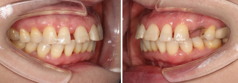 50대 치아교정 돌출 치아벌어짐 중년교정 관련 이미지 6