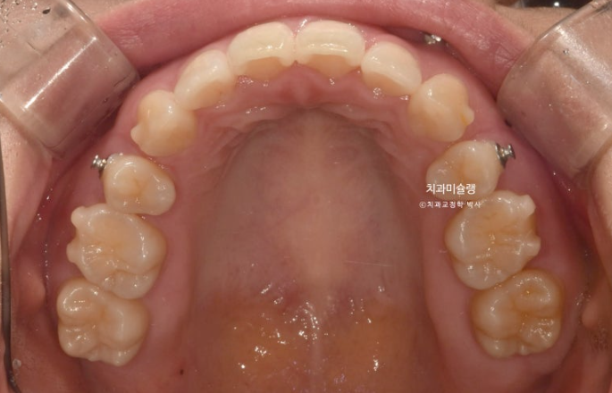 돌출입 덧니 발치 교정 인비절라인 교정 후기 관련 이미지 12