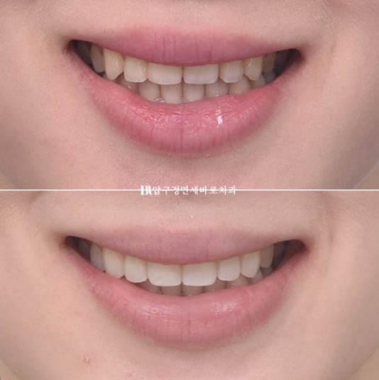 Non-Prep Veneer Review | A Case Naturally Improving Gaps Between the Front Teeth and the Smile Line image 12