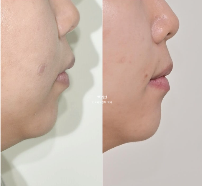 돌출입 교정 인비절라인 발치 교정 개방교합 치료 후기 관련 이미지 28