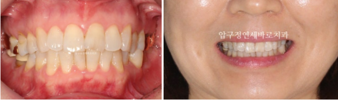 40대 후반 치아교정 해도 될까요? 관련 이미지 2