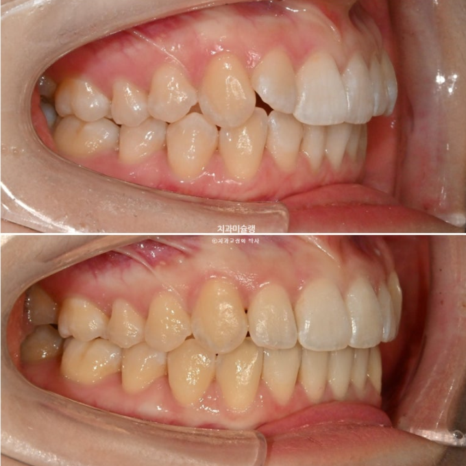 덧니 인비절라인 라이트 잇몸미소 거미스마일 중심선 블랙트라이앵글 관련 이미지 19