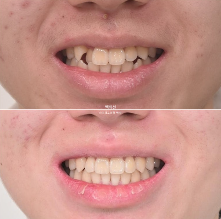유학생 교정 덧니 반대교합 인비절라인 라이트 치료기간 관련 이미지 17