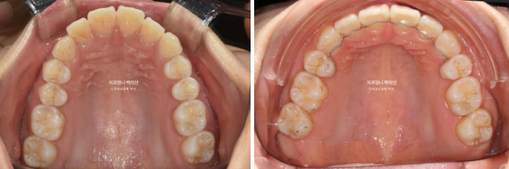 30대 돌출입 발치교정 입술부전증 치료 관련 이미지 12