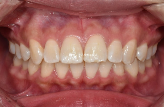 돌출입 교정 입동굴 클리피씨 교정 후기 관련 이미지 2