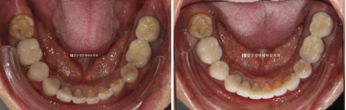 50대 라미네이트 삭제 없이 하는 법? 관련 이미지 14