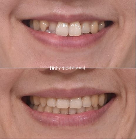 토끼이빨 치아교정 ? 토끼이빨 교정 치료기간은 어떻게 되나요? 관련 이미지 10