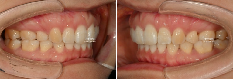 돌출입 덧니 발치 교정 인비절라인 교정 후기 관련 이미지 21