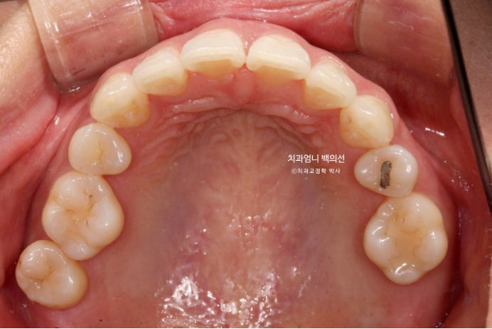 옥니 역교정 재교정 무턱 교정 치료기간 1년 10개월 관련 이미지 4