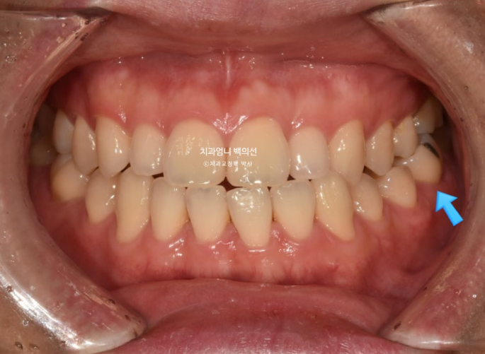 주걱턱 교정 반대교합 소구치 선천적 결손 부정교합 비발치 교정 후기 관련 이미지 2