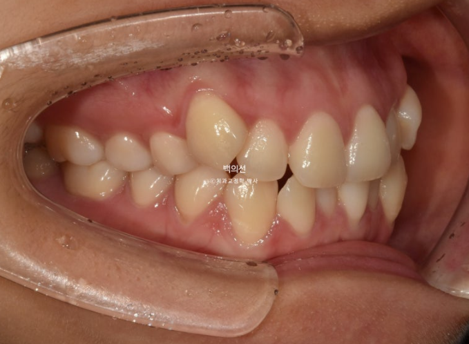덧니 발치교정 클리피씨 입매 부작용 인중 입술 잇몸 퇴축 관련 이미지 4