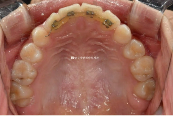 어린이 투명교정 인비절라인 틴 덧니 교정 후기 관련 이미지 3