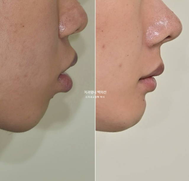 돌출입 발치 교정 인비절라인 후기 미니스크류 관련 이미지 23