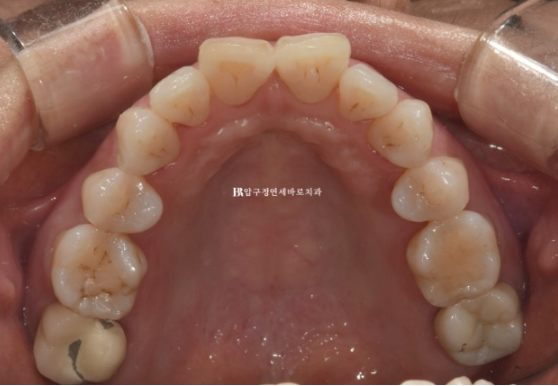 50대 중년교정 인비절라인 라이트 나비치아 교정 앞니 교정 후기 관련 이미지 5