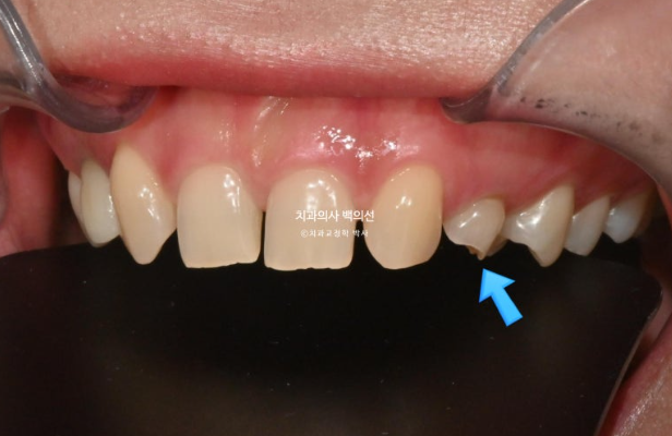 앞니 선천적 결손 벌어짐 잔존 유치 무삭제 라미네이트 관련 이미지 5