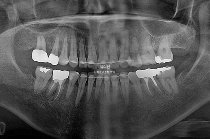 거미스마일 교정 돌출입 발치교정 입술부전 호두턱 치료기간 2년반 관련 이미지 26