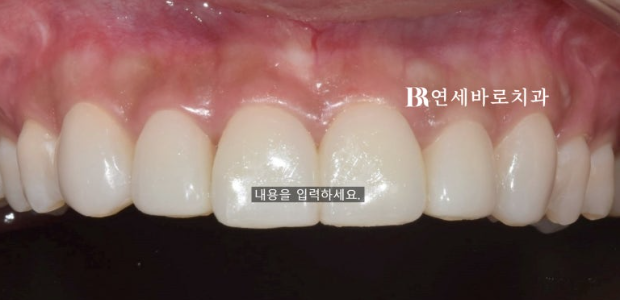 무삭제 라미네이트 젤라미 정말 최소삭제도 안할까? 관련 이미지 3