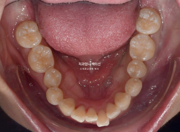 돌출입 교정 인비절라인 발치 교정 후기 관련 이미지 6