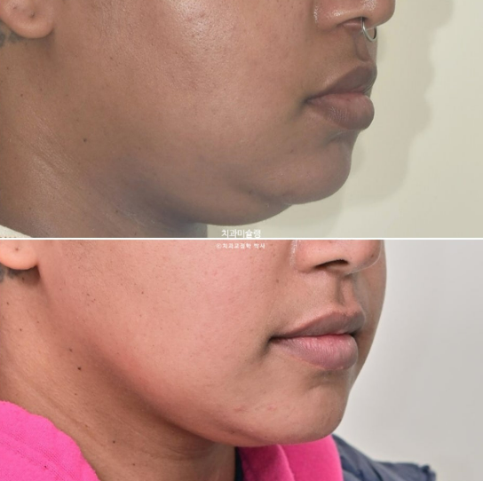 Extraction & re-orthodontics with Clippy-C, intrusion for dental implant. 관련 이미지 23