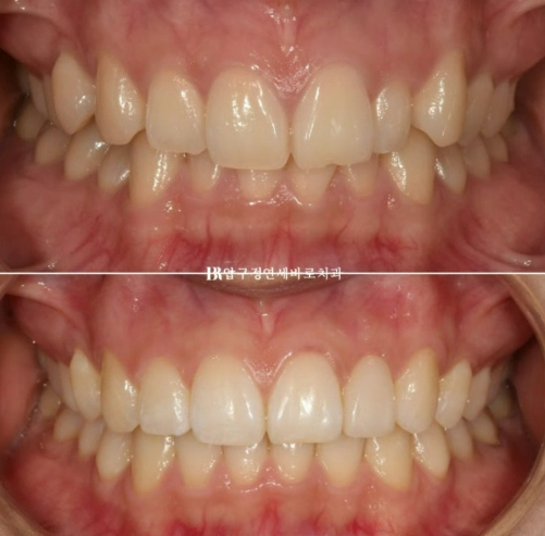 급속 교정 앞니부분교정 치료 무삭제 라미네이트 후기 관련 이미지 1