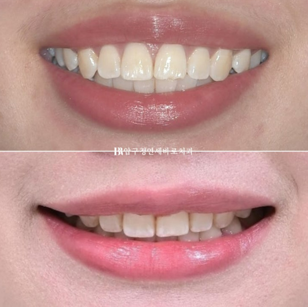 How Do the Buccal Corridors and Smile Line Change After Extraction Treatment for Protruding Teeth?|An Orthodontic Case That Also Improved Lip Incompetence image 13