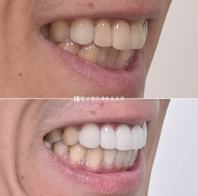 40대 중년 치아교정 인비절라인 라이트 치료기간 8개월 관련 이미지 15
