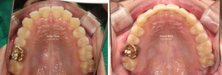 인비절라인 비발치 앞니 돌출 교정 치료기간 2년 5개월 관련 이미지 15