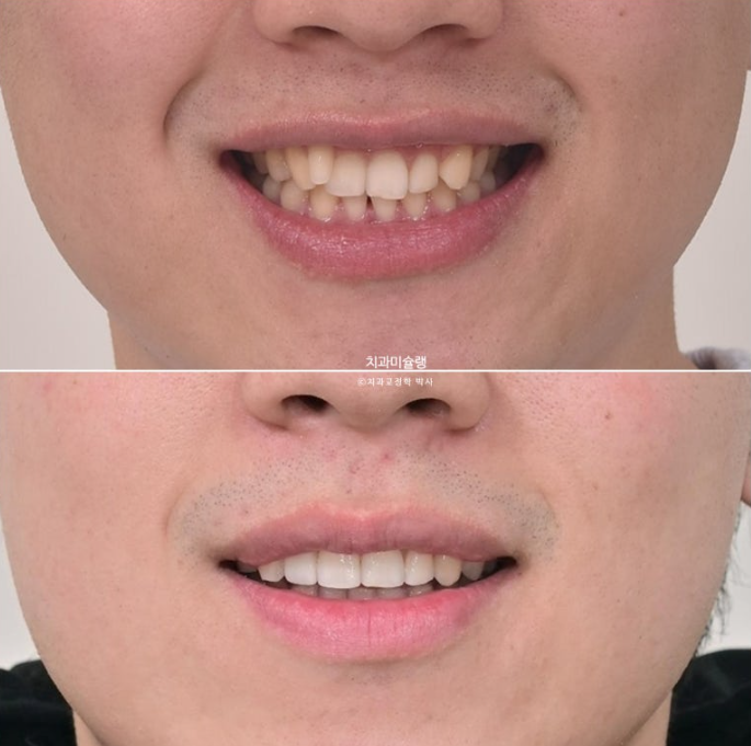 옥니 덧니 교정 왜소치 선천적 결손 3전치 무삭제 라미네이트 인비절라인 교정 관련 이미지 23