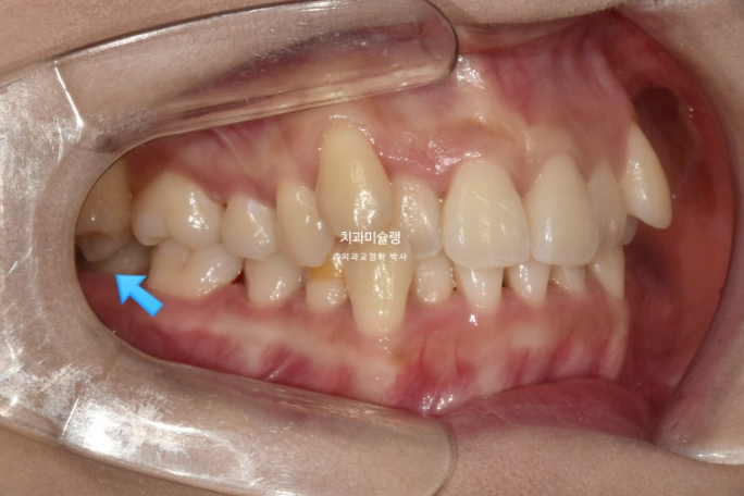 인비절라인 비발치 제2대구치 발치 사랑니 대체 교정 심한 덧니 교정 치료 관련 이미지 3