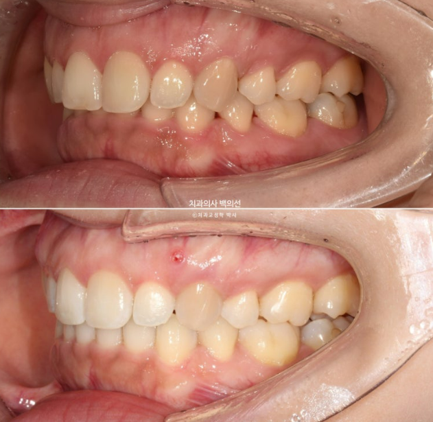 인비절라인 라이트 재교정 발치공간 벌어짐 ? 관련 이미지 11