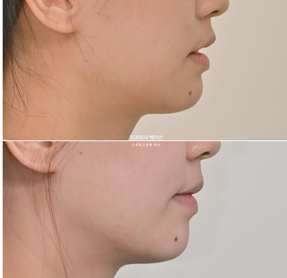 인비절라인 라이트 재교정 발치공간 벌어짐 ? 관련 이미지 14