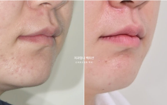 Inward-Tilted Teeth Orthodontic Treatment Review | A Real Case of Treating Congenitally Missing Lower Incisor (Three Lower Front Teeth) Without Extractions image 16