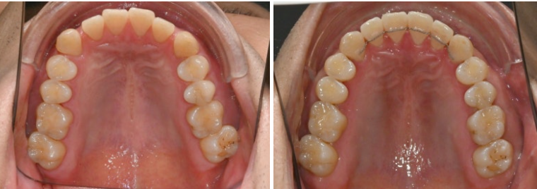 가위교합 벌어짐 중심선 과개교합 인비절라인 라이트 교정 관련 이미지 14
