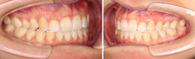 앞니 단기 부분교정 재교정 개방교합 교정 후기 관련 이미지 9