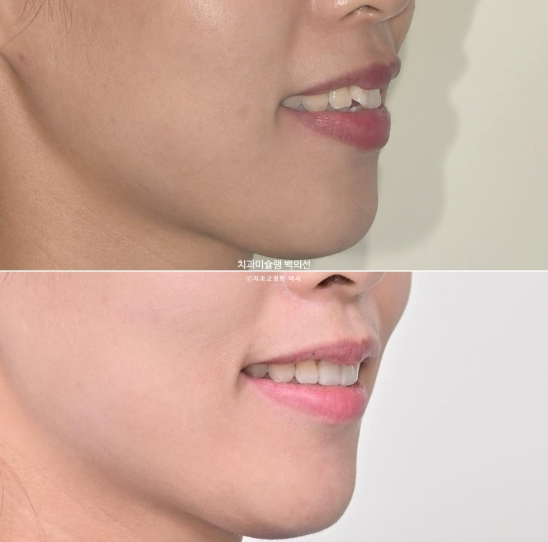 인비절라인 돌출입 발치교정 임플란트 없이 사랑니 대체 관련 이미지 28