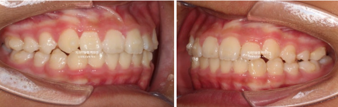 덧니 반대교합 과개교합 인비절라인 퍼스트 악궁확장 어린이 교정 관련 이미지 6