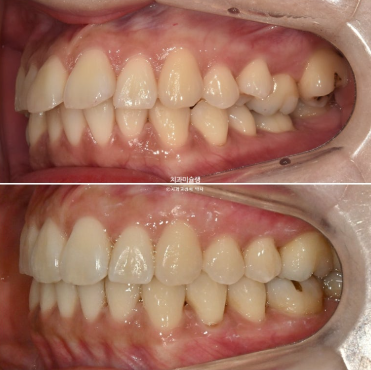 비발치 돌출입 인비절라인 교정 가위교합 중심선 맞추기 관련 이미지 23