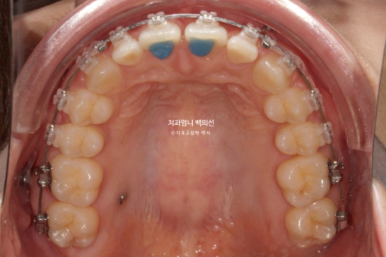 Inward-Tilted Teeth Orthodontic Treatment Review | Actual Case Improved with Non-Extraction Orthodontic Treatment for Gummy Smile, Deep Overbite & Gum Asymmetry — Gangnam Orthodontic Clinic image 7