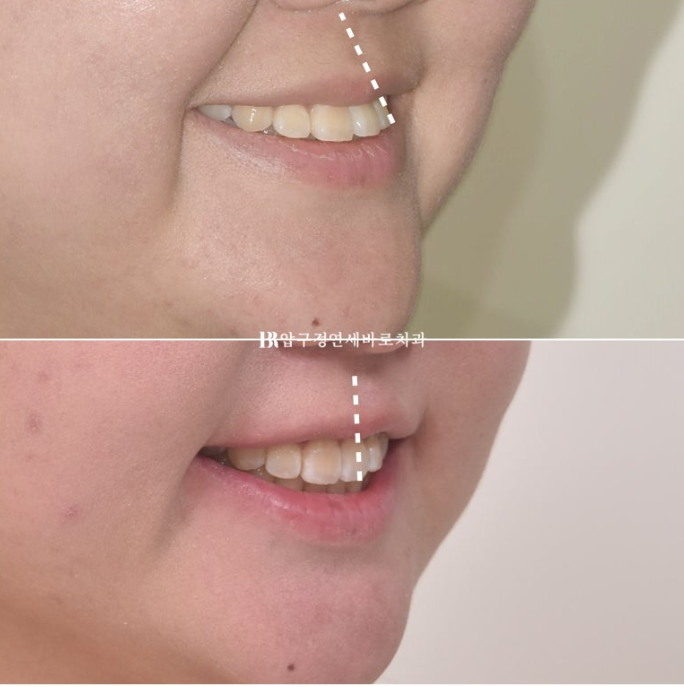 인비절라인라이트 재교정 뻐드렁니 교정 돌출 교정 관련 이미지 9