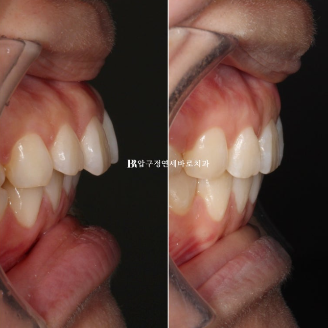 돌출입 발치교정으로 거미스마일&middot;잇몸미소&middot;입술부전까지 개선한 사례｜입동굴 변화까지 확인해보세요 관련 이미지 14