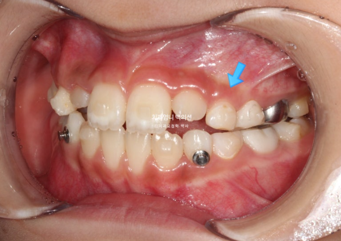 어린이 교정 인비절라인 퍼스트 비대칭 반대교합 어린이 성장 교정 관련 이미지 8
