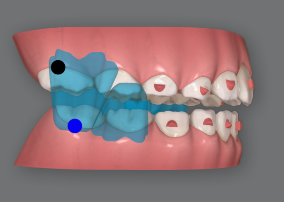 Invisalign First Correction for a Retruded Chin in a Child Orthodontic Treatment for Protrusion image 9