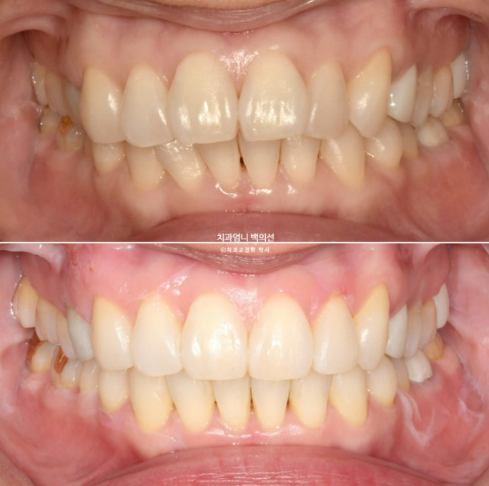 50대 치아교정 교합평면 기울어짐 토끼이 덧니 교정? 관련 이미지 10