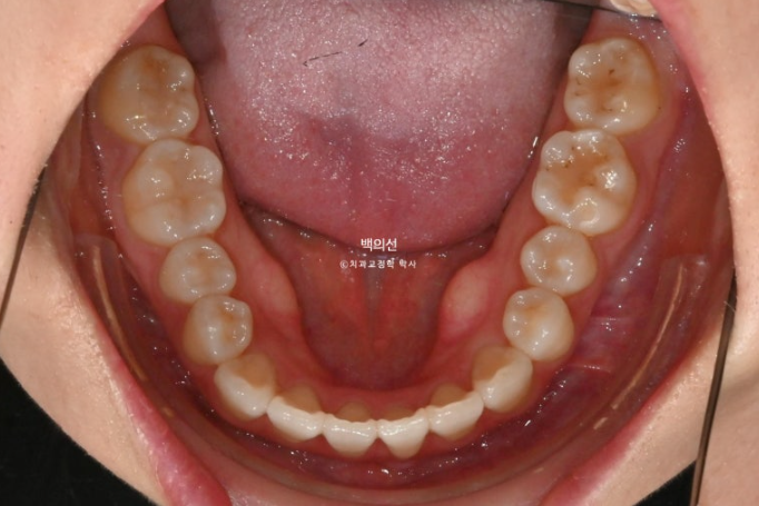 매복 결손 잔존유치 라미네이트 크라운 캔팅 인비절라인 라이트 치료 관련 이미지 6