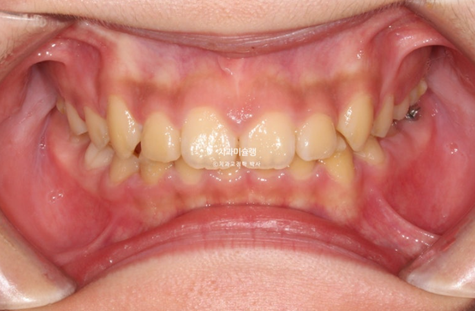 선천적 결손 잔존유치 과개교합 돌출입 인비절라인 퍼스트 어린이 투명교정 치료기간 관련 이미지 11